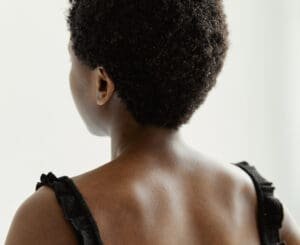 Raleigh Acupuncture Hives Treatment